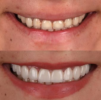 Aesthetic,Dentistry,Emax,And,Zirconium,Porcelain,Veneer,Treatment.,Glass,Ceramic Emax Porcelain Crowns for Woman with Dental Clinic Turkey