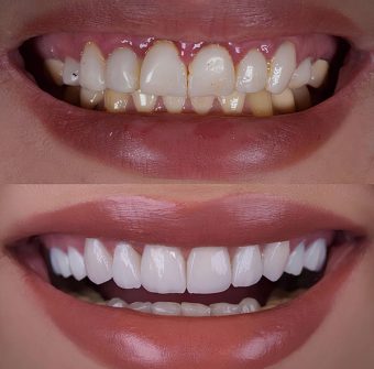 Aesthetic,Smile,Design,Treatment,In,Dental,Dentistry.,Smile,Treatment,Of Smile Design Before After