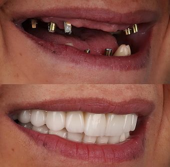 In,Dental,Implant,Jaw,Surgery,Treatment,,The,All-on-4,Or,All-on-x, Dental Implants