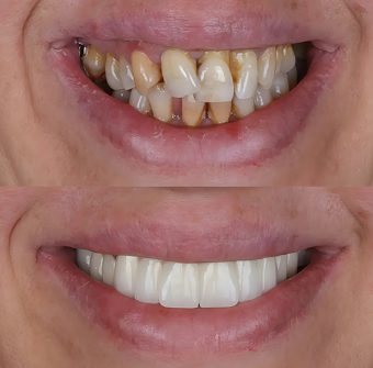 Aesthetic,Smile,Design,Treatment,In,Dental,Dentistry.,Dental,Treatment,With Smile Design with Crown