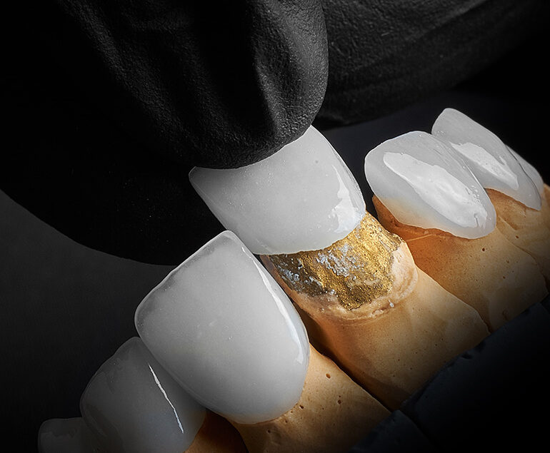 Porcelain Veneers