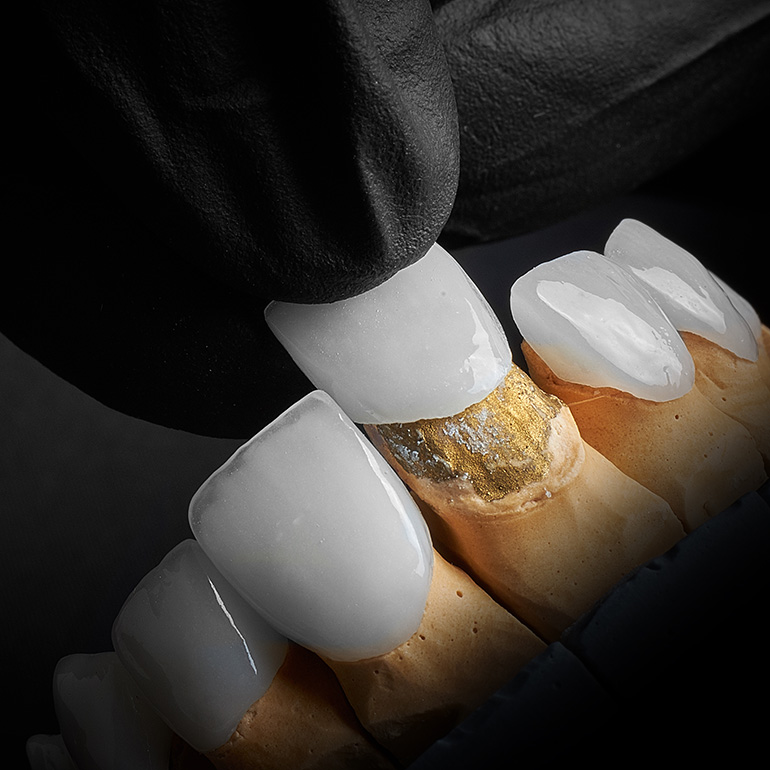 Porcelain Veneers
