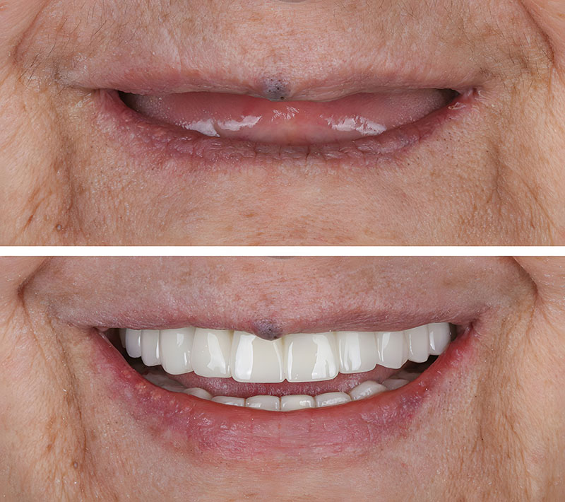 Implant,Surgery,Treatment,Applied,In,Edentulous,Jaws,In,Dental,Dentistry. All on 4 for woman before after