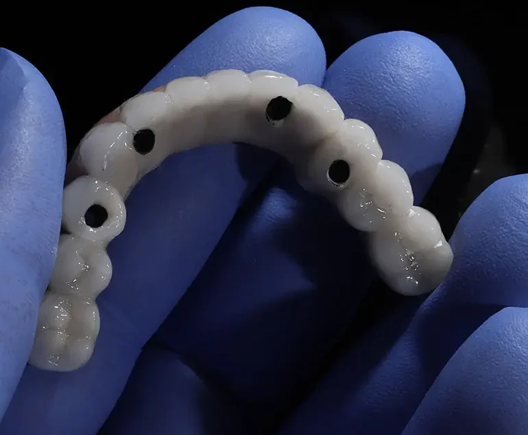 All on 4 Dental Implant Prothesis