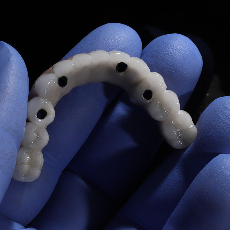 all-on-4 dental implants
