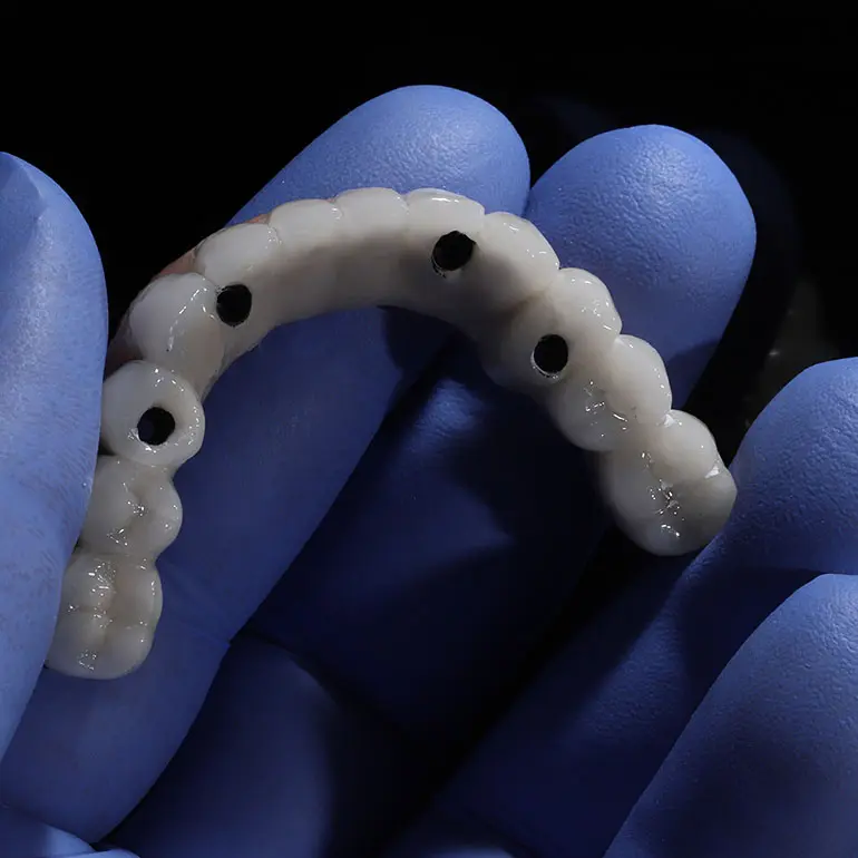 All on 4 Dental Implant Prothesis