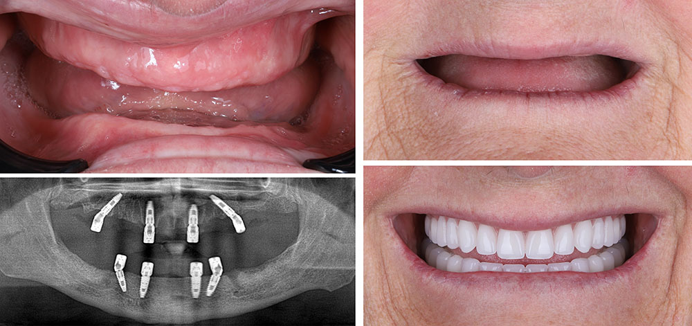 All on 4 Implant Surgery