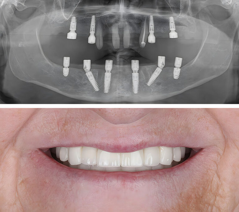 Lower jaw all on 6