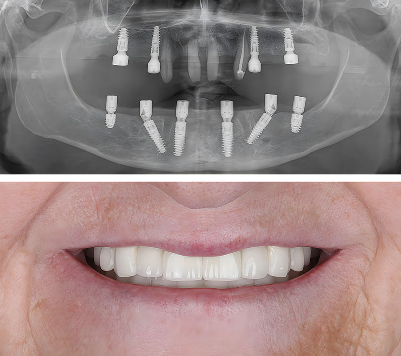 Lower jaw all on 6