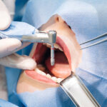 Dental Implant Surgery