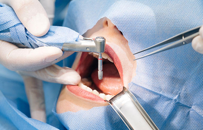 Dental Implant Surgery