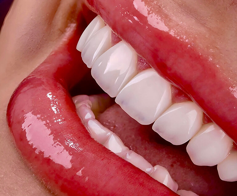 Hollywood Smile
