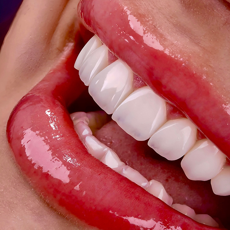 Hollywood Smile