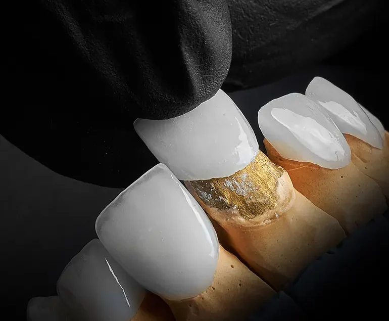 Porcelain Veneers