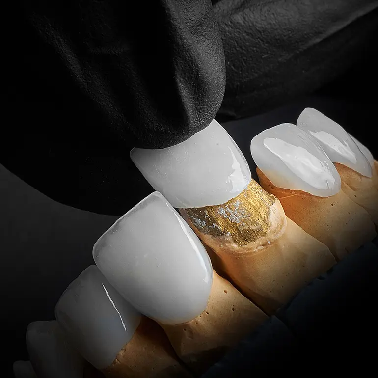 Porcelain Veneers