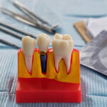 Dental Implant Process in Turkey