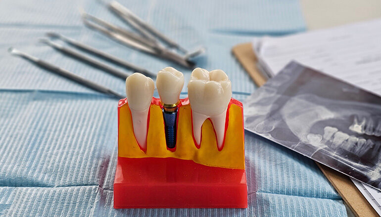 Dental Implant Process in Turkey