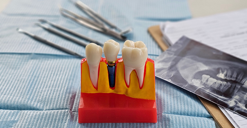 Dental Implant Process in Turkey