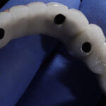 All o 4 prosthesis