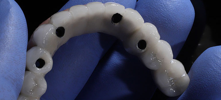 All o 4 prosthesis