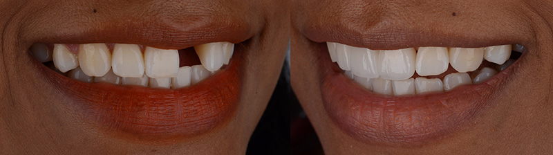 Full mouth rehabilitation procedure at Dental Clinic Turkey