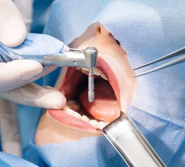 Dental Implant Surgery