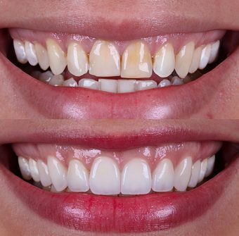 Dental Veneers Before and After
